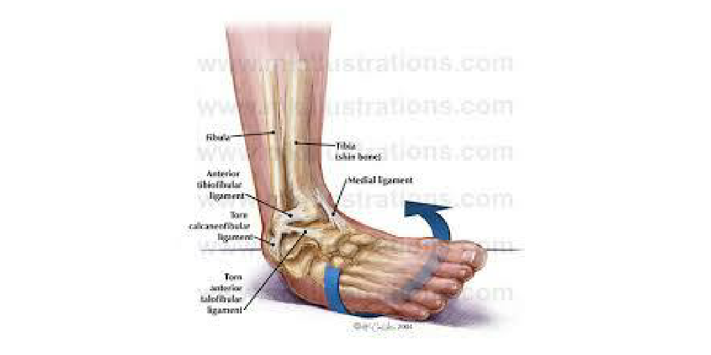 Lower Extremity Injuries by Ale Raciti - Infogram